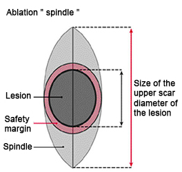 Skin tumors - Simple excision